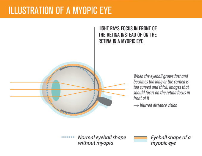 MiYOSMART | Hoya Vision