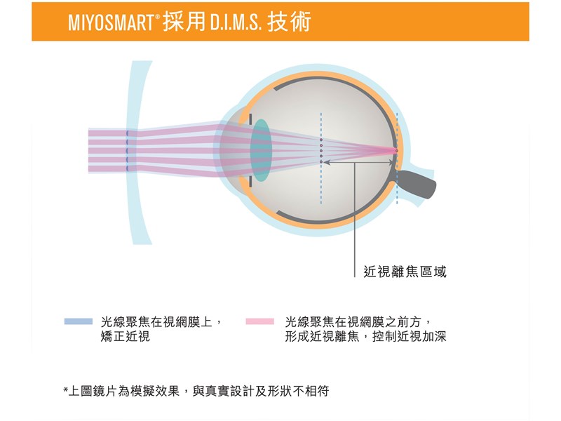 Miyosmart 革命dims鏡片技術減慢兒童近視加深 Hoya Vision